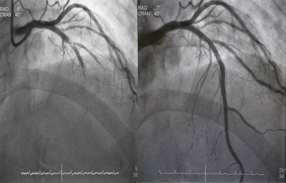 Comparison of pre-post percutaneous coronary intervention (PCI) at proximal to mid left anterior descending artery (LAD) with drug eluting stent (DES).