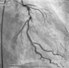Coronary angiogram (CAG) was performed left circumflex artery (LCx) stenosis and chronic total...