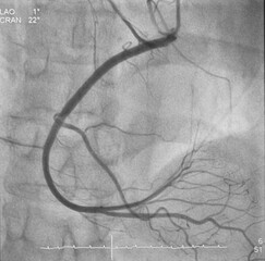 Coronary angiogram (CAG) was performed right coronary artery (RCA).