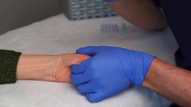 Physiotherapy session, using the Dry Needling technique, to treat rhizarthrosis, puncturing the opponens pollicis muscle of the thumb and the first interosseous muscle.
