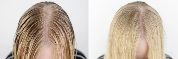 Before and after. The girl looks in front of the mirror at her oily hair. Problematic scalp and increased secretion of the sebaceous glands. Hair care. Oily hair care and treatment concept