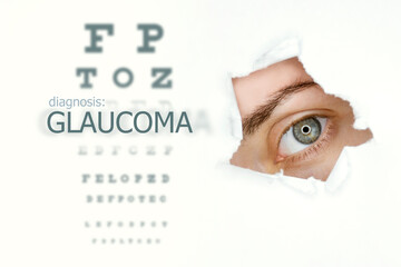 Woman`s eye looking trough teared hole in paper, word Glaucoma on left. Eye disease concept...