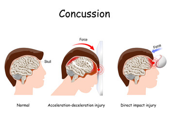 concussion in sport. mild traumatic brain injury
