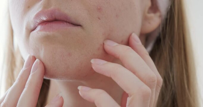Close up of sad woman touching acne on her face. 