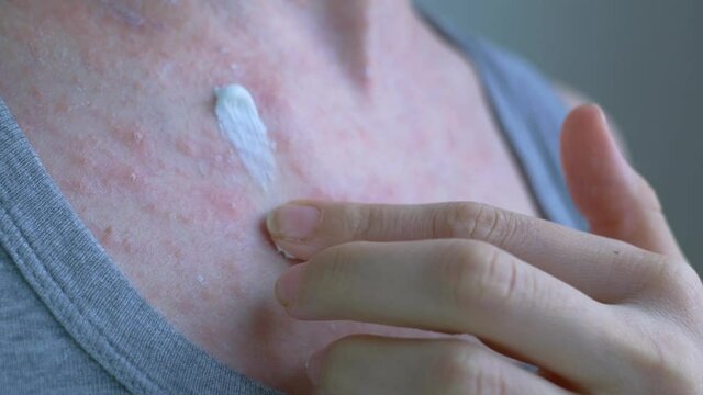 A little ointment is taken from a tube of ointment and applied to the skin, inflammation with small reddish acne. Viral diseases. Close-up.