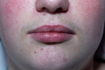 Fototapeta premium Teenage acne looking very sore