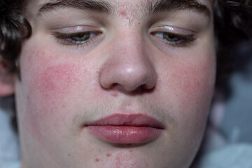 Teenage acne looking very sore