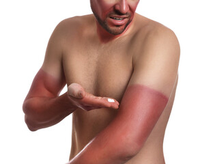 Man applying cream on sunburn against white background, closeup