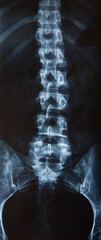 Radiografía del cuerpo humano, espalda con escoliosis.