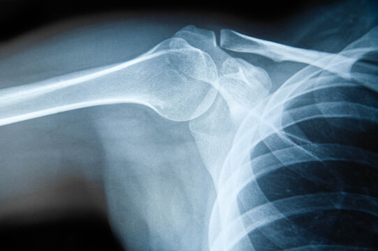 Radiografía del cuerpo humano, hombro.