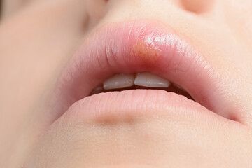 Close up female lips with symptoms of herpes virus