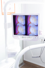 Screen in the dental office with a macro shot of the tooth.