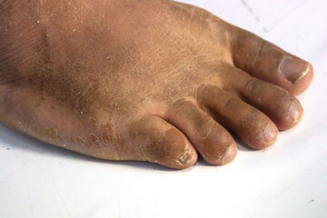 close up of dried and dead feet skin Foot peeling