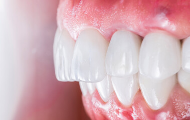 created new smile by crowns implants and veneers