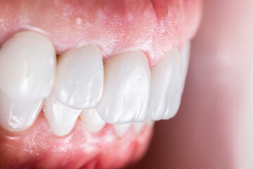 created new smile by crowns implants and veneers