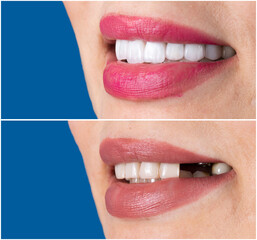 Naklejka premium created new smile by crowns implants and veneers