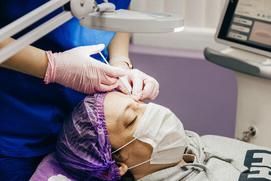 Patient getting laser mole removal. skin moles treatment