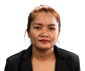 Fototapeta premium Female facial skin disease