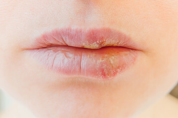 Fototapeta premium Close up of girl lips affected by herpes. Treatment of herpes infection and virus. Part of young woman face, lips with herpes affected. Beauty dermatology concept.