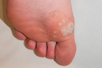 Sole of foot showing mosaic plantar wart and other verrucas including the black spot clotted blood vessel centres - obrazy, fototapety, plakaty