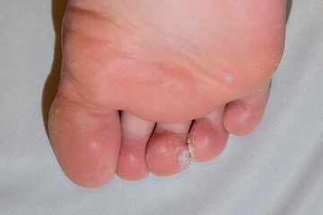 Sole of foot showing mosaic plantar wart verrucas between toes with dry rough skin