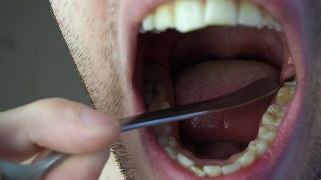 Rotten carious tooth close-up. Tooth before removal