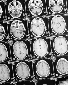 Bild einer Magnetresonaztomographie, MRT,  Computertomographie, Röntgenbild.
Kopf mit Gehirn im seitlichen Querschnitt