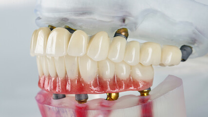 temporary dentures of the upper and lower jaws in bite on a white background