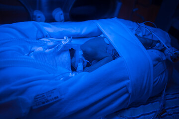 Premature baby under blue light, receiving phototherapy UV treatment
