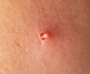 inflamed acne on the skin of the face