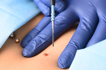 A dermatologist surgeon removes a neoplasm - a mole or nevus from the patient's abdomen with a radio wave knife. Aesthetic surgery, prevention of melanoma.