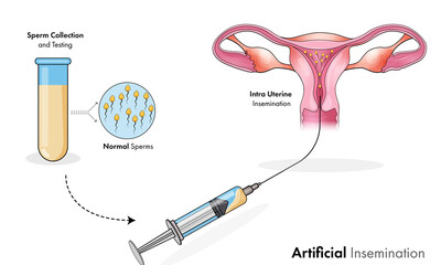 human anatomy: artificial insemination for women pregnancy.  
