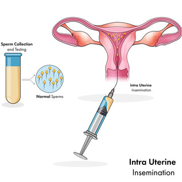 intra uterine form of artificial insemination for pregnancy vector illustration 