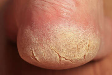 Close-up of a man's cracked heel. Problem area of the foot requiring medical and cosmetic treatment. Rough yellowed dry skin dies off in parts.