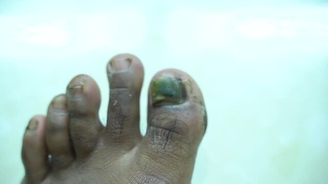 Male feet infected by germs that cause nail dislocations.