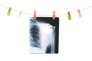 Photo of x-ray human shoulder fixed with colorful clothespins on a rope isolated on white background.