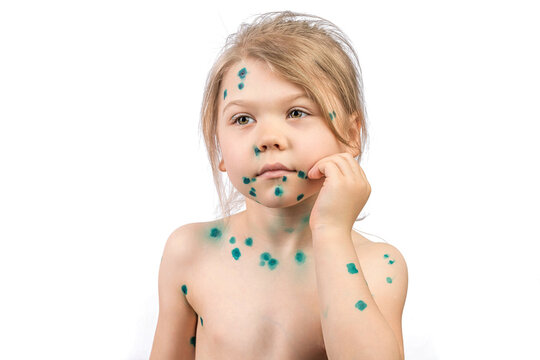 A seven year old girl suffers from an infectious disease of chickenpox, her pimples are smeared with brilliant green.