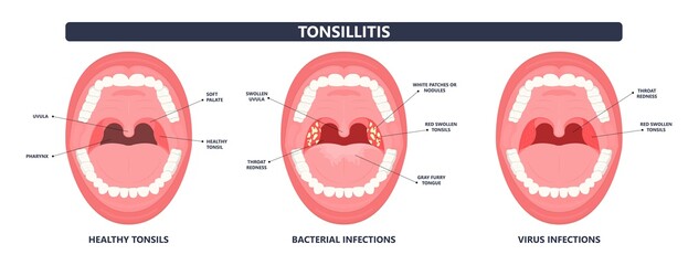 Tonsil Stones crypts viral virus gland strep throat sore enlarged lymph nodes neck pain swollen pus white mouth bacteria Herpes simplex HSV cold fever Epstein Barr fetid bad odor oral laser aureus