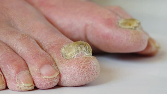 Skin disease,Close up of nail fungus, toe fungus, foot dermatitis.