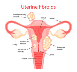 Fibroids. Diseases of the female reproductive system. Vector illustration in flat cartoon style