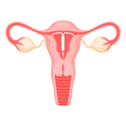 The method of IUD-contraception. Control and protection of pregnancy. Intrauterine device in the uterus. vector illustration in a flat style.
