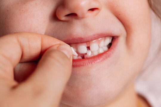 close-up doctor's hand pulls the first baby tooth from the lower jaw of a six-year-old child.
