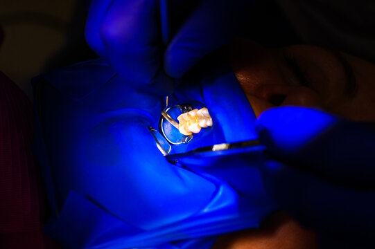 Dental procedure, treatment of the upper masticatory tooth, modern dental treatment with a rubber dam.