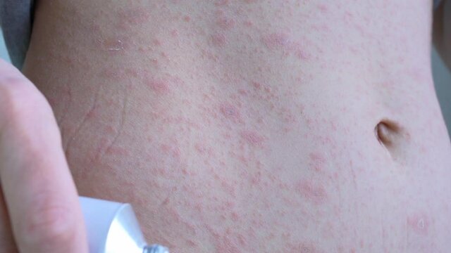 Household clothes on the body are lifted up by hand, then the right side of the abdominal cavity with reddened spots is smeared with ointment and rubbed in circular motions. Viral diseases. Close-up.