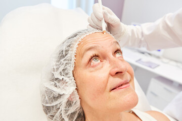 Stirnfalten einer Patientin für Facelift markieren