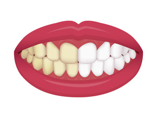 Teeth whitening vector illustration / before and after