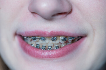 Obraz premium Cute young girl with dental braces. Girl teenager smiling