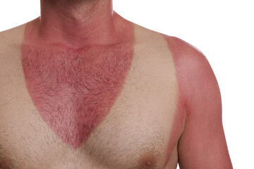 Fototapeta premium Man with sunburned skin on white background, closeup