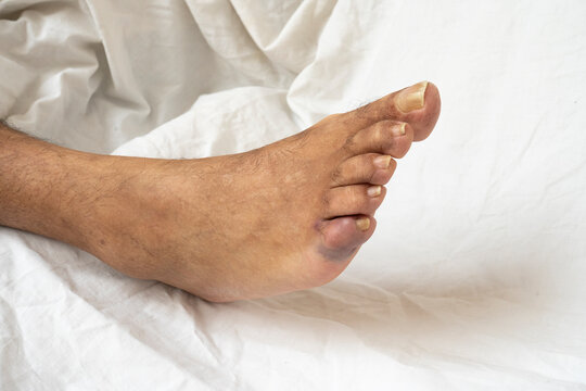 Bruising little foot toe. Close up on the broken little toe of a senior man showing discoloration.