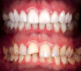 Perfect smile before and after veneers bleach of zircon arch ceramic prothesis Implants crowns....